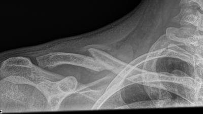 Sleutelbeen fractuur